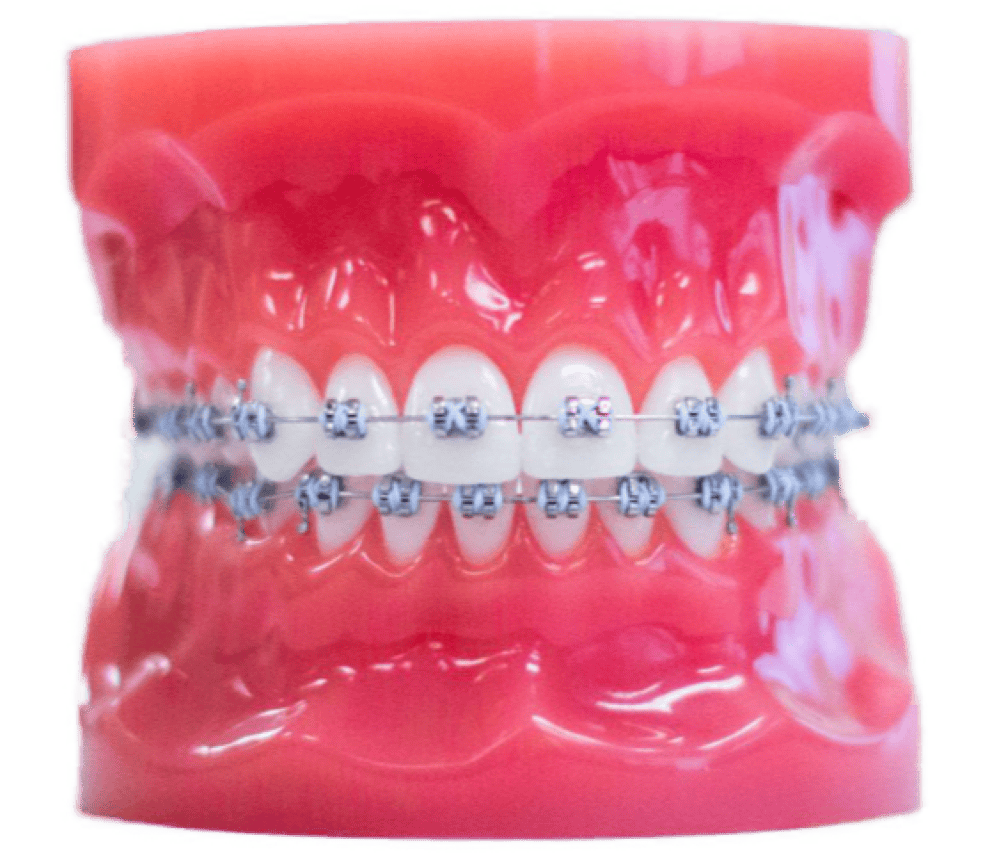 metal braces on plastic model