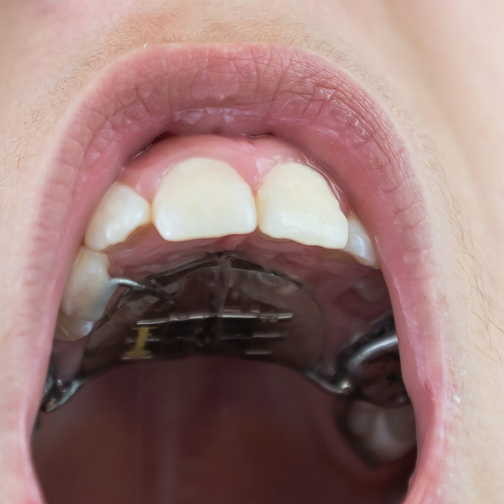 Little,Girl,With,A,Plate,On,Her,Teeth Little,Girl,With,A,Plate,On,Her,Teeth